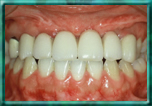 implant results of front teeth